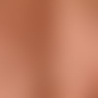 Differenzialdiagnose: Elastorrhexis, papulöse

Diagnose: Komedonenakne: Zahlreiche Komedeonen (Pf...