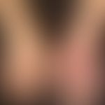 Acrodermatitis chronica atrophicans: Frau, 77 Jahre. Subjektiv symptomlose Rötung und teigige Sch...