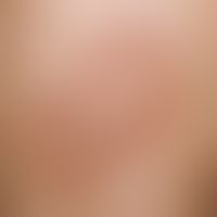 Differenzialdiagnose:&nbsp;Granuloma anulare

Diagnose:&nbsp;Granulomatosis disciformis chronica ...