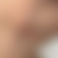 Naevus comedonicus: Frau, 71 J. Die streifenförmigen Komedonen seit der Jugend. Die Komedonen wer...