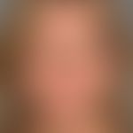 Ozempic-Face:&nbsp;Ausgangsbefund, s. nachfolgende Abbildung.

&nbsp;
