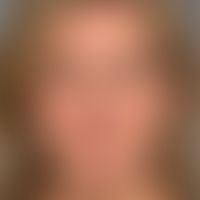 Ozempic-Face:&nbsp;Ausgangsbefund, s. nachfolgende Abbildung.

&nbsp;
