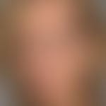 Ozempic-Face: Starke, kosmetisch störende Volumenreduktion nach längerzeitiger GLP-1-Therapie&nbs...