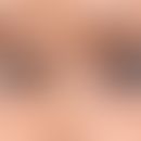 Wimpernverlängerung durch Prostaglandin-Analoga: vor und nach Therapie. Abb. mittels KI erstellt....