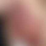 Erysipelas carcinomatosum (Lymphangiosis carcinomatosa) Abb mittel KI erstellt. Vorlage: Kerkhoff...