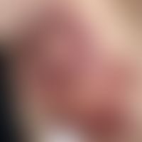 Erysipelas carcinomatosum (Lymphangiosis carcinomatosa) Abb mittel KI erstellt. Vorlage: Kerkhoff...
