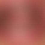 Pyostomatitis vegetans: schwere, flächenhafte pustulöse Mukositis mit dichter Pustelbildung. Spri...