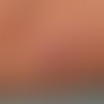 Pyostomatitis vegetans:&nbsp;kutane Pustulationen mit flächenhafter Pustulation.&nbsp;Abb. entnom...