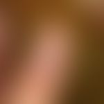 Pyostomatitis vegetans:&nbsp;eitrige Paronychie mit flächenhafter Pustulation.&nbsp;Abb. entnomme...