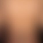 Morbus Addison: homogene Hyperpigmentierung des Rückens bei einem 35-jährigen Mann; besonders an ...