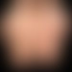 Morbus Addison: die Handflächen des zuvor beschriebenen Patienten. Pigmentierung der Handlinien s...