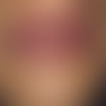 Morbus Addison: generalisierte Hyperpigmentierung mit fleckiger, grau-bräunlicher Pigmenteinlager...