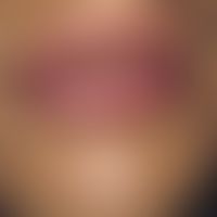 Addison's disease: generalized hyperpigmentation with spotty, grayish-brownish pigment deposits i...