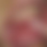 Addison's disease: grayish-brownish mucous membrane pigmentation of the gingiva in a 22-year-old ...