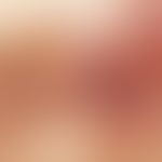 Morbus Addison: Auflichtmikroskopie: Schlierenartige, braune (epidermales Pigment) bis schiefergr...