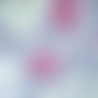 Adnexkarzinom, mikrozystisches. Die Tumorzellverbände bestehen aus mittelgroßen, überwiegend kubo...