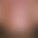 Adnexkarzinom, mikrozystisches. Hautfarben bis gelbliche, derbe Plaque, schwer abgrenzbar, mit ob...