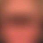 Airborne Contact dermatitis:&nbsp;chronisches (>6 Wochen) flächenhaftes, enorm juckendes und b...