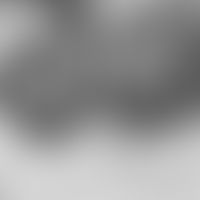 Acantholysis. electron microscopy: individual acantholytic keratinocytes (aK) released from the c...
