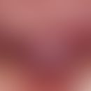 Akanthome, infektiöse. Scharf begrenzter, nicht druckschmerzhafter, rosa-farbener Knoten an der r...