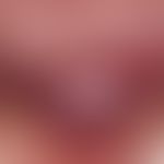 Acanthomas, infectious. Sharply defined, not pressure-painful, pink-coloured lump on the right ch...