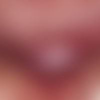 Acanthomas, infectious. Sharply defined, not pressure-painful, pink-coloured lump on the right ch...