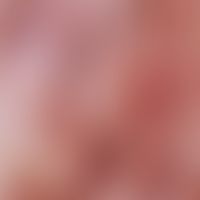 Akanthopapillom. Auflichtmikroskopie (Ausschnitt aus einem Viruspapillom vom Hals): Runde bis pol...