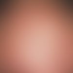 Acne comedonica, multiple comedones with a partially inflammatory reaction in the forehead area o...
