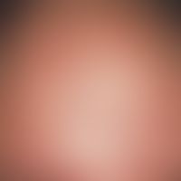 Acne comedonica, multiple comedones with a partially inflammatory reaction in the forehead area o...