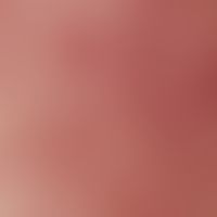Acne comedonica. reflected-light microscopy without contact medium (perinasal region; 21-year-old...