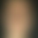 Acne conglobata, large inflammatory lumps, isolated pustules in the area of the face with emphasi...