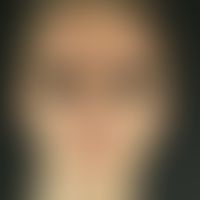 Acne conglobata, large inflammatory lumps, isolated pustules in the area of the face with emphasi...