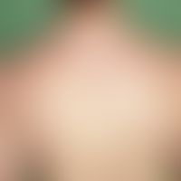 Acne conglobata. Inflammatory lumps, large bowl-shaped scars, single keloids around the shoulders.
