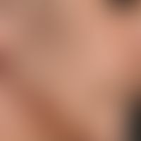 Acne conglobata:&nbsp;vernarbter Ausheilungszustand. Komedonen im Bereich von Nase, Wangen und Ha...