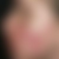 Acne conglobata: symmetrically distributed inflammatory papules and pustules with cystic transfor...