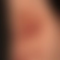 Acne conglobata:&nbsp;betont inverse Lokalisation mit flächenhafter narbiger Induration der gesam...