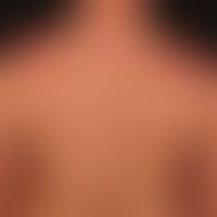 Acne conglobata: Zustand nach narbiger Abheilung eines Schubs der Acne conglobata.&nbsp;
