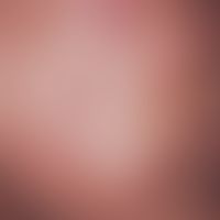 Acne cystica. Dicht gesäte, gelblich-weiße, hautfarbene&nbsp;Talgretentionszysten sowie zahlreich...