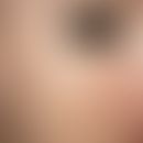 Acne excoriée des jeunes filles. Zahlreiche, weiße, umschriebene, schüsselförmige Narben, wenige ...