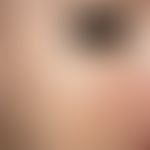 Acne excoriée des jeunes filles. Zahlreiche, weiße, umschriebene, schüsselförmige Narben, wenige ...