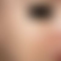 Acne excoriée des jeunes filles. numerous, white, circumscribed, bowl-shaped scars, few inflammat...