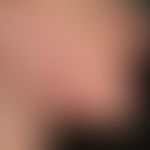 Acne excoriée des jeunes filles. Multiple, symmetrisch verteilte, zunehmende, entzündliche, rote ...