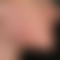 Acne excoriée des jeunes filles. multiple, symmetrically distributed, increasing, inflammatory, r...
