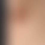 Acne inversa: multiple, chronisch stationäre, intertriginös lokalisierte, disseminierte, flach el...
