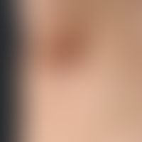 Acne inversa: multiple, chronisch stationäre, intertriginös lokalisierte, disseminierte, flach el...