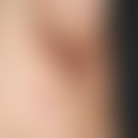 Acne inversa. Detailaufnahme der chronisch stationären, schmerzhaften, wulstigen und konsistenzve...