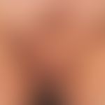 Acne inversa. Ausgeprägter Befund bei einem adipösen 47 Jahre alten Patienten. Die multiplen, chr...