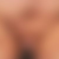 Acne inversa. pronounced findings in an obese 47-year-old patient. the multiple, chronically stat...