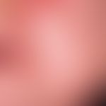 Acne infantum. Seit 2 Monaten schubweise aufgetretene, 2-4 mm große, rote, entzündliche Papeln un...