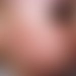 Acne infantum. Zahlreiche, dicht stehende Papeln und Pusteln bei einem 3-jährigen Jungen.